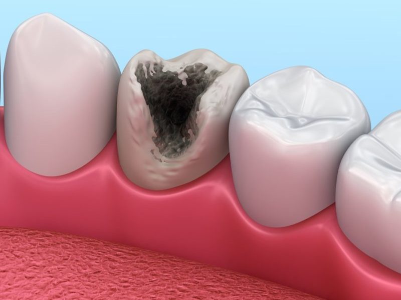 Основне про карієс зубів