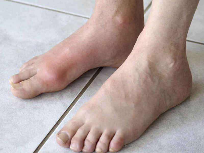 Набряки ніг у літніх: причини, діагностика та лікування